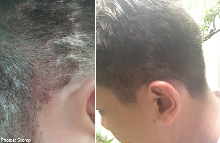 Man Suffers Scalp Infection After Salon Over Bleaches His Hair