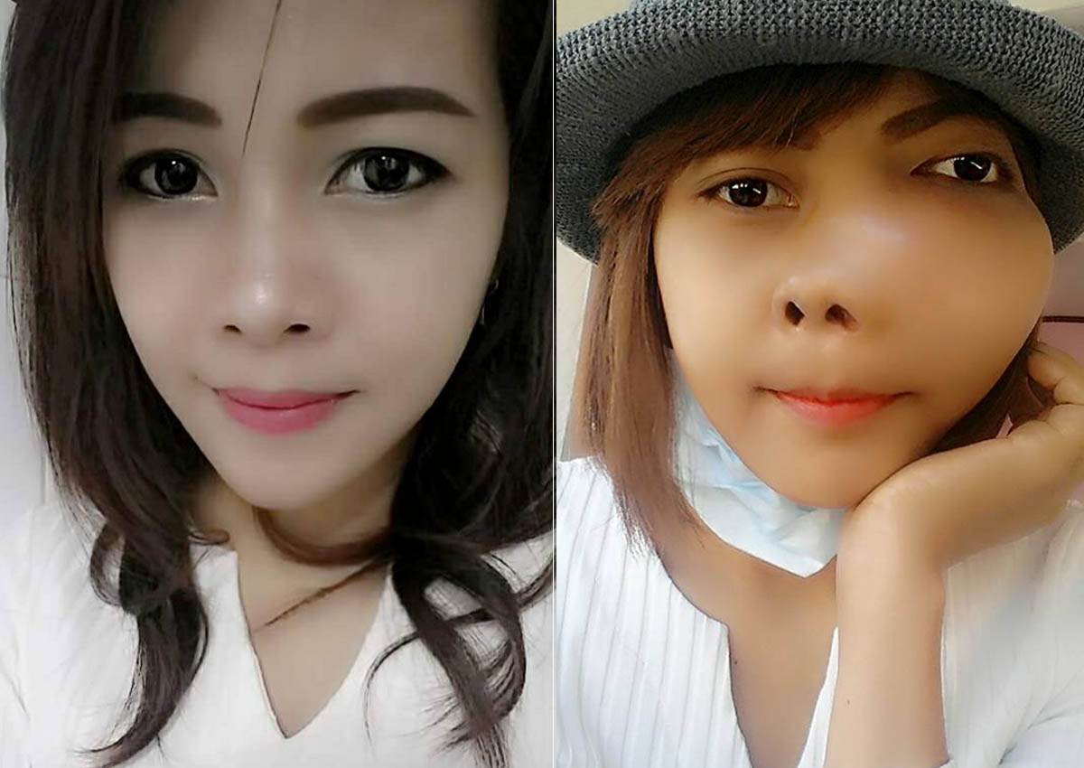 Thai Woman With Bone Cancer Disfigured By Massive Tumour On Face