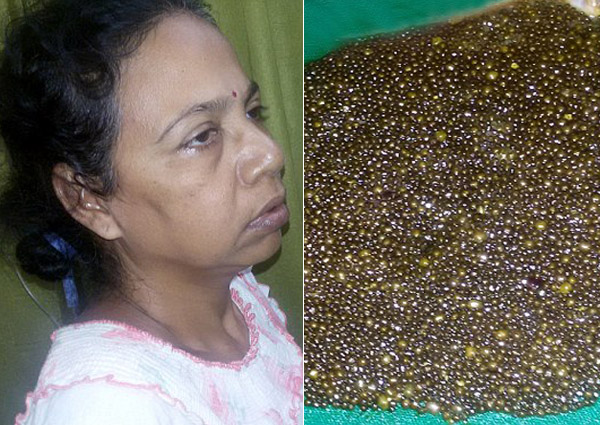 Indian woman's severe stomach pains reveal close to 12,000 stones in