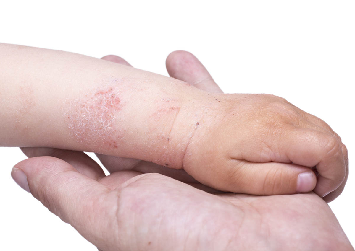 8-ways-to-help-children-with-eczema-reduce-itchiness-health-health