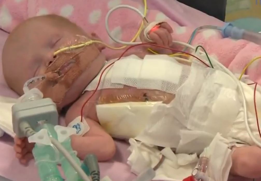 Newborn with heart outside chest survives surgery, World News - AsiaOne