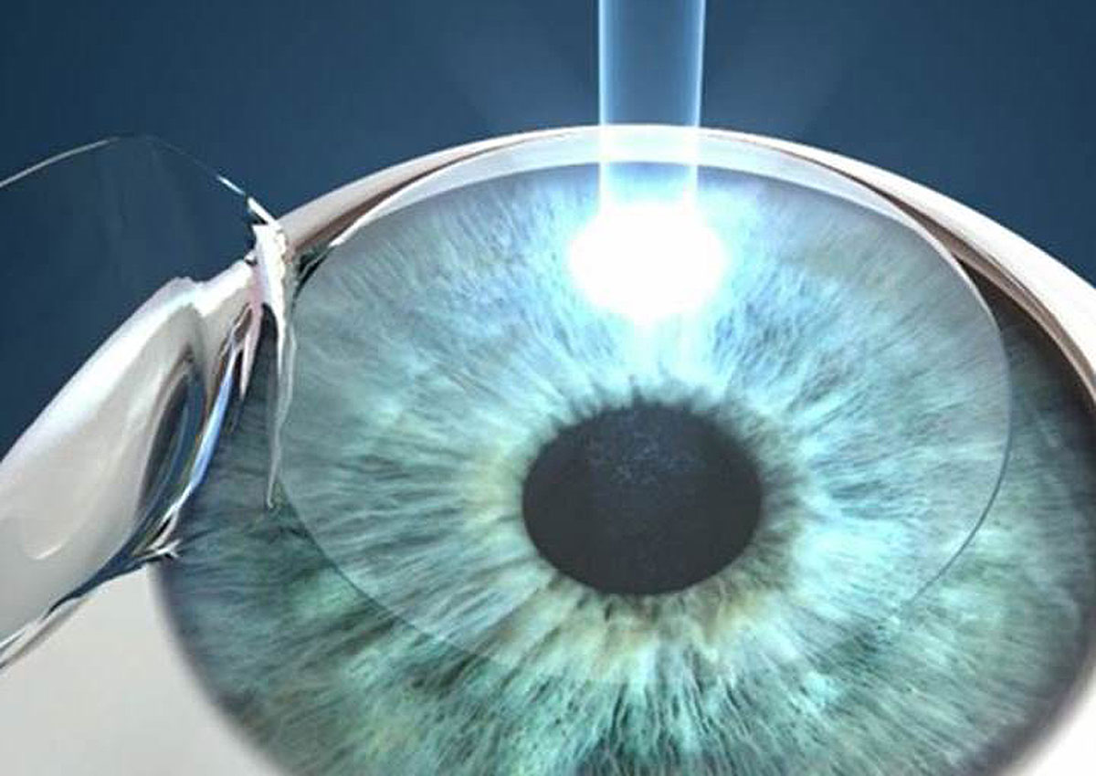 Lasik After Cataract Surgery Is Possible News Asiaone