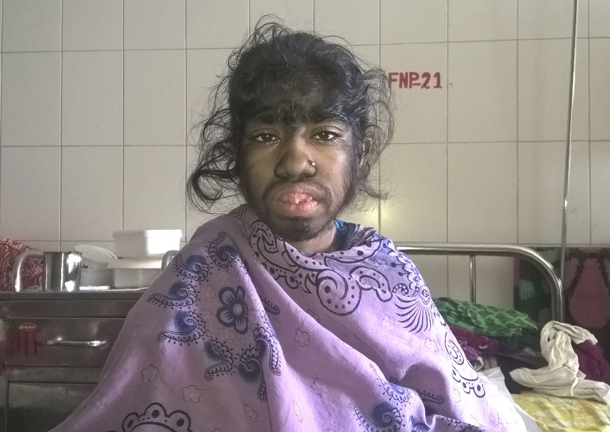 Werewolf Bangladeshi Girl Seeks Help For Rare Excess Hair Condition Asia News Asiaone