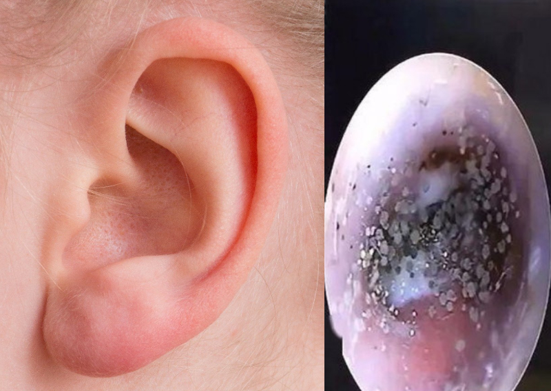  Mould Found Growing In Boy s Ear Canal Said To Be Due To Wearing 