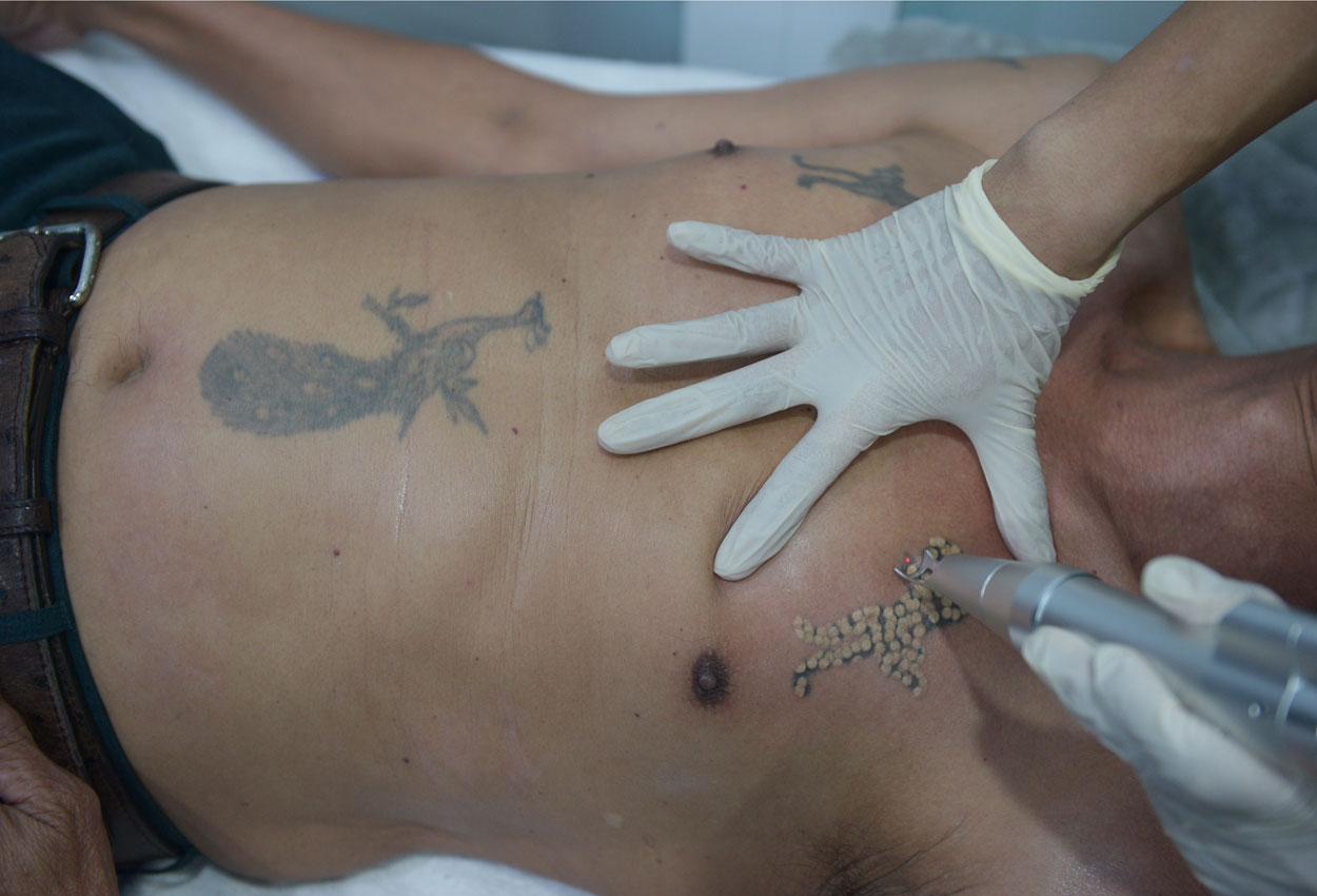 Tattoos a new way to alert about medical condition