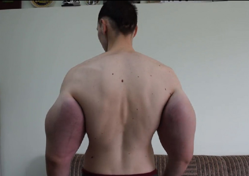 Russian injects oil into muscles, shows off Hulk-like arms, Health News