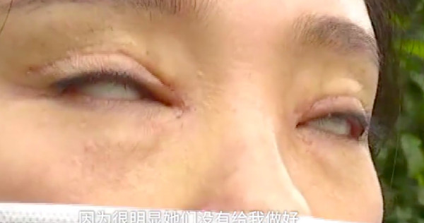 double eyelid surgery sg