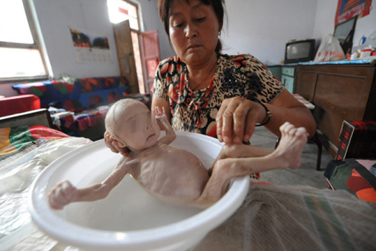 Baby boy born without anus now on the brink of death, Health, Health
