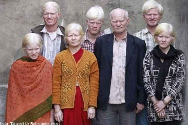 Indian family of 10 the world's biggest albino family, Health News