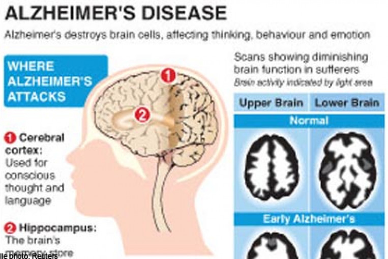 Goal for Alzheimer's drug by 2025 too ambitious?, Health News AsiaOne