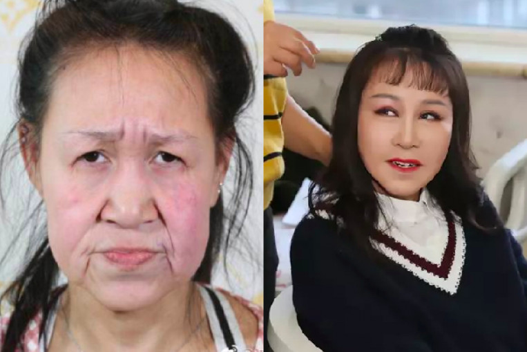 plastic surgery to look asian